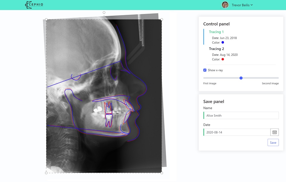 Cephalometric superimposition done in Cephio